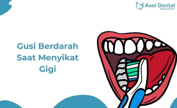 Gusi Berdarah Saat Sikat Gigi, Mungkin Ini Sebabnya! Kenapa Gusi Berdarah Saat Sikat Gigi?