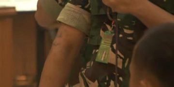 Bekas Luka Hitam di Tubuh Akibat Penyiraman Air Keras